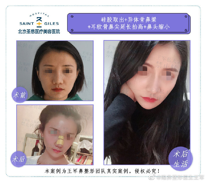 北京鼻综合专家排名李长赋王军李劲良刘彦军师俊莉巫文云王志坚哪个最好？