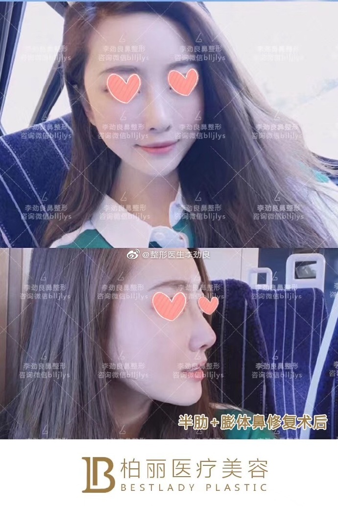 北京鼻综合专家排名李长赋王军李劲良刘彦军师俊莉巫文云王志坚哪个最好？