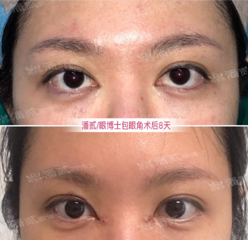 中国顶尖双眼皮修复专家：潘贰和田国静哪个修复双眼皮技术好？