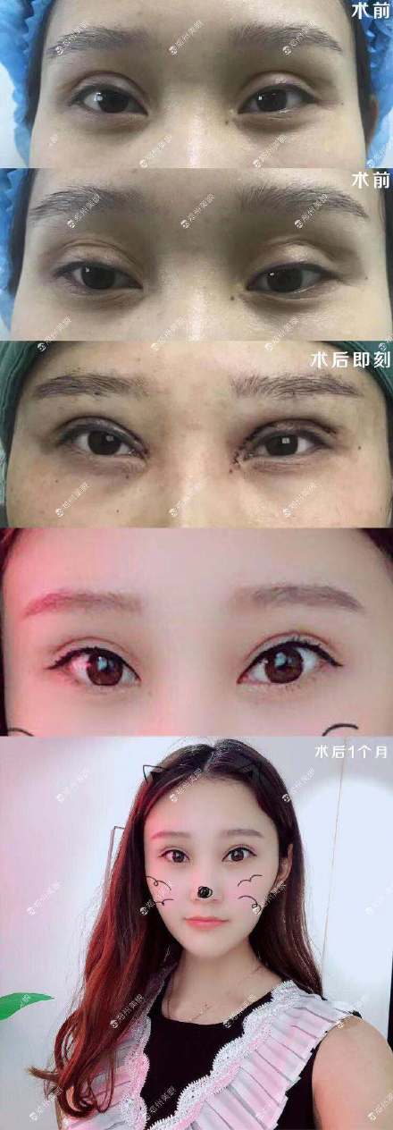 中国顶尖双眼皮修复专家：潘贰和田国静哪个修复双眼皮技术好？