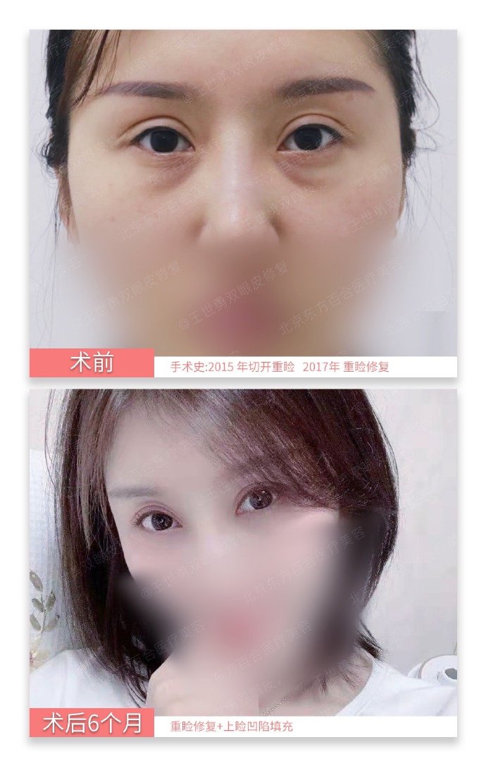 修复双眼皮王世勇金国华王振军哪个好？王振军金国华王世勇双眼皮修复预约