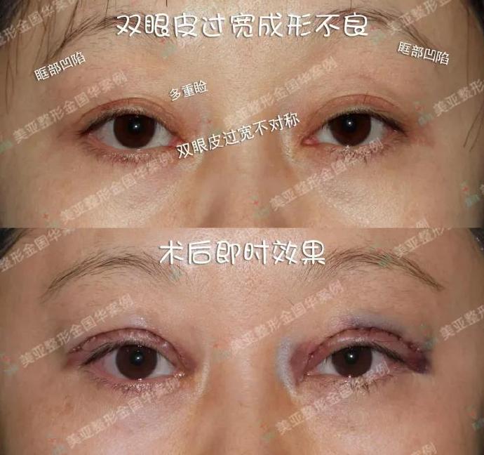 修复双眼皮王世勇金国华王振军哪个好？王振军金国华王世勇双眼皮修复预约