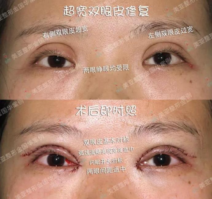 修复双眼皮王世勇金国华王振军哪个好？王振军金国华王世勇双眼皮修复预约