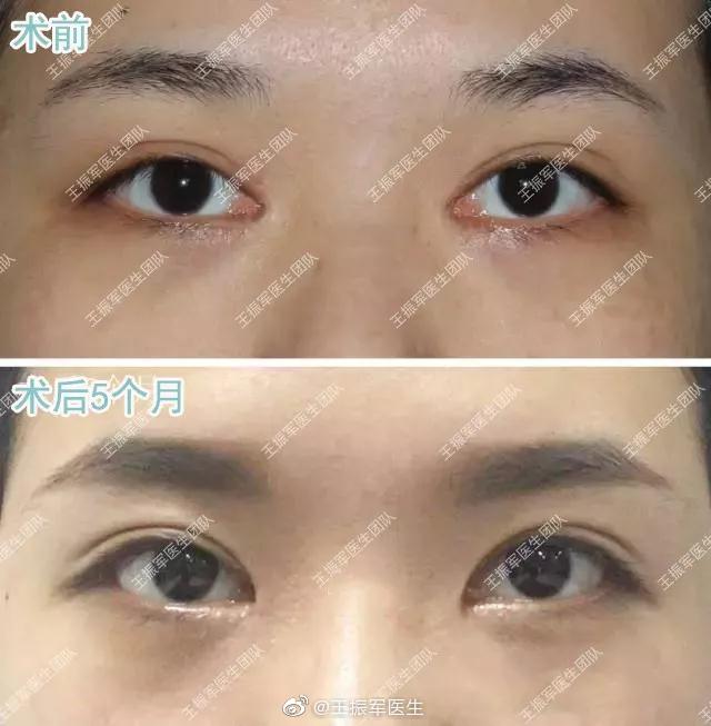 修复双眼皮王世勇金国华王振军哪个好？王振军金国华王世勇双眼皮修复预约