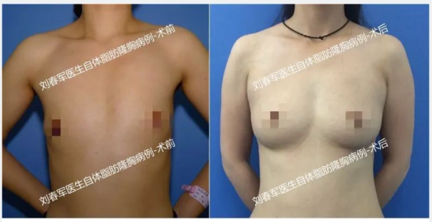 北京八大处脂肪丰胸隆胸多少钱？八大处做丰胸最好的医生是谁？