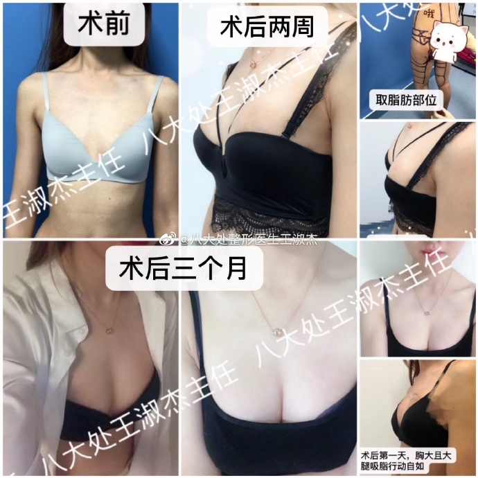 北京八大处脂肪丰胸隆胸多少钱？八大处做丰胸最好的医生是谁？