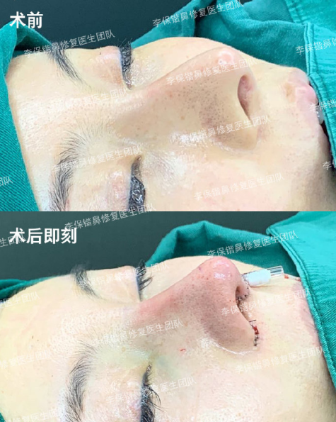 杭州鼻修复最好的医生有哪些？杭州隆鼻修复专家哪个口碑最好？