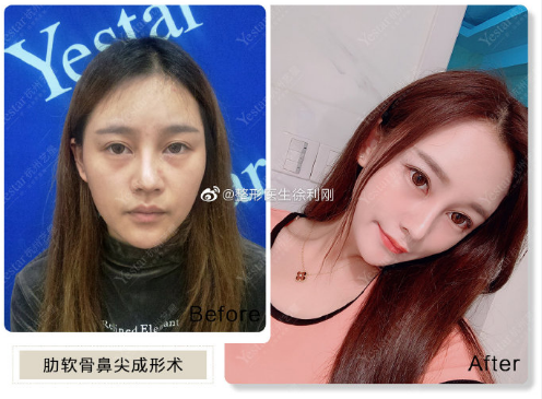 杭州鼻修复最好的医生有哪些？杭州隆鼻修复专家哪个口碑最好？