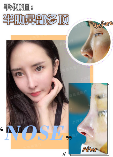 上海隆鼻鼻修复顶级专家推荐：王会勇和陈付国（预约）哪个医生做鼻子好？