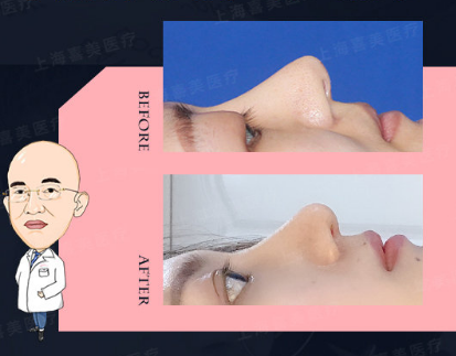 上海隆鼻鼻修复顶级专家推荐：王会勇和陈付国（预约）哪个医生做鼻子好？