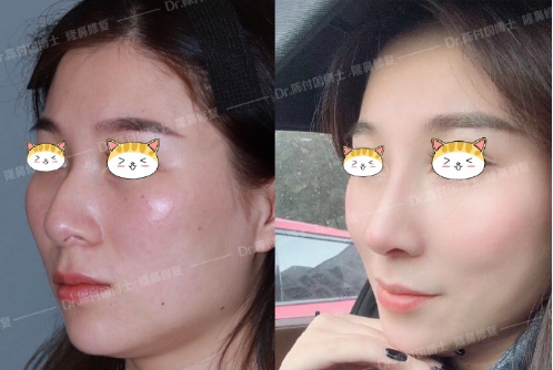 上海隆鼻鼻修复顶级专家推荐：王会勇和陈付国（预约）哪个医生做鼻子好？