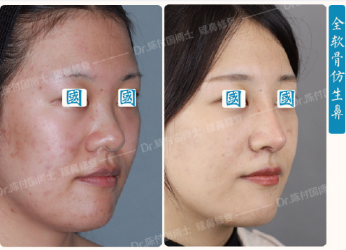 上海隆鼻鼻修复顶级专家推荐：王会勇和陈付国（预约）哪个医生做鼻子好？