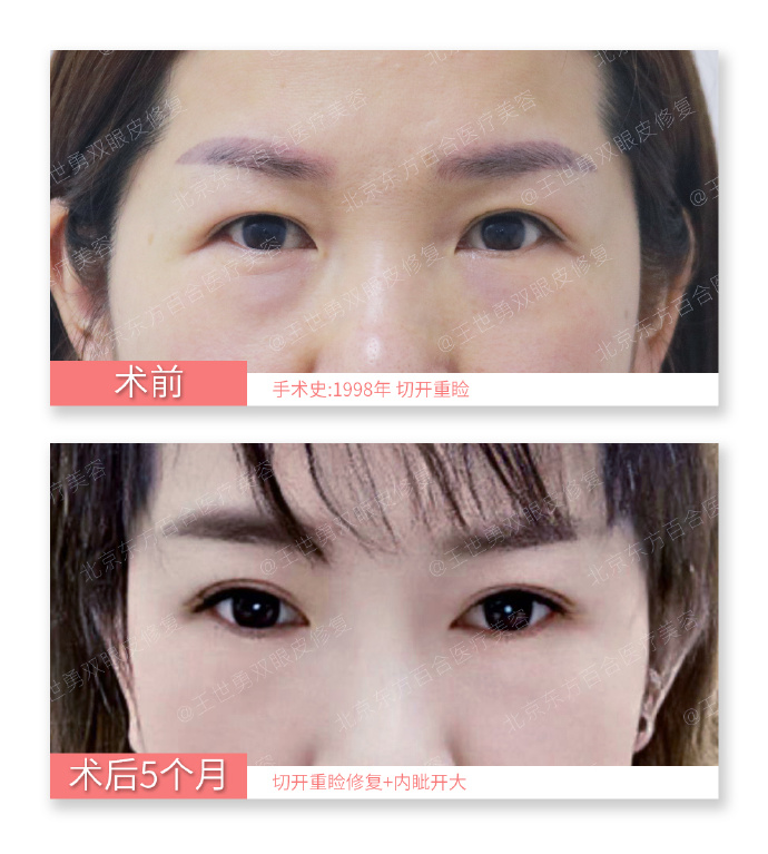 国内知名度较高双眼皮修复专家王世勇刘风卓王振军田国静刘辅容杜园园谁最好？