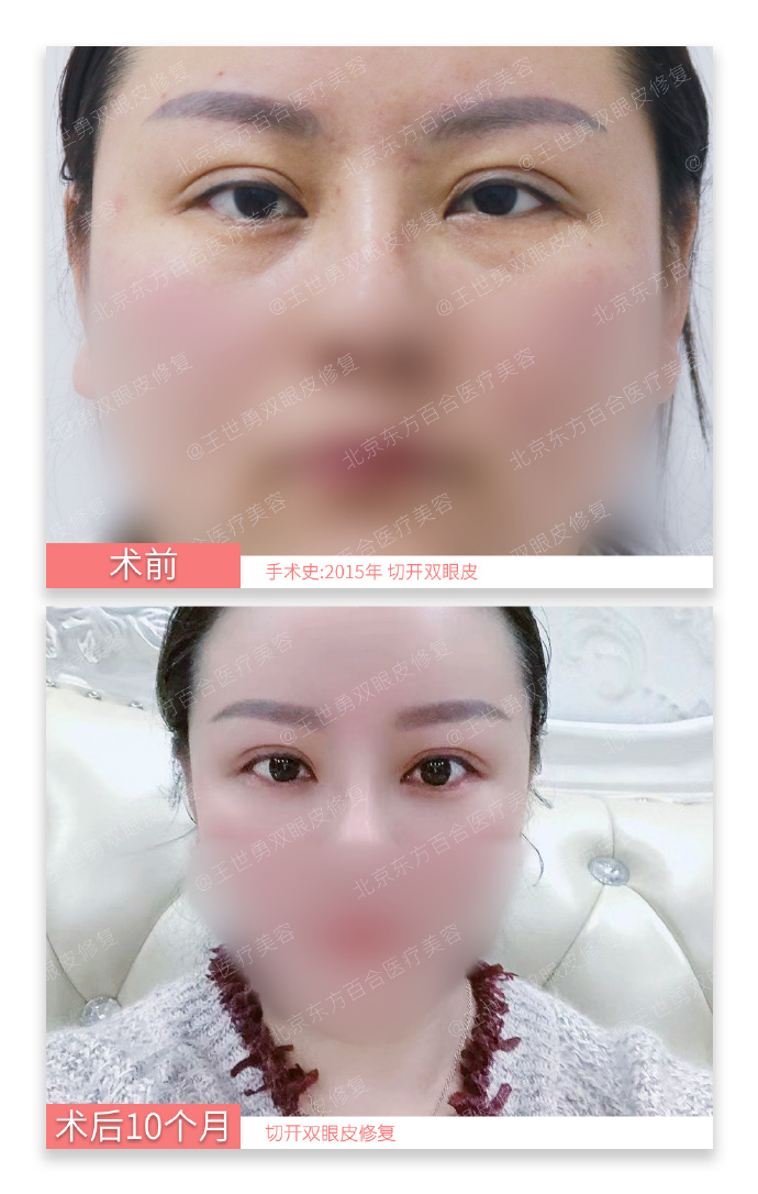 国内知名度较高双眼皮修复专家王世勇刘风卓王振军田国静刘辅容杜园园谁最好？