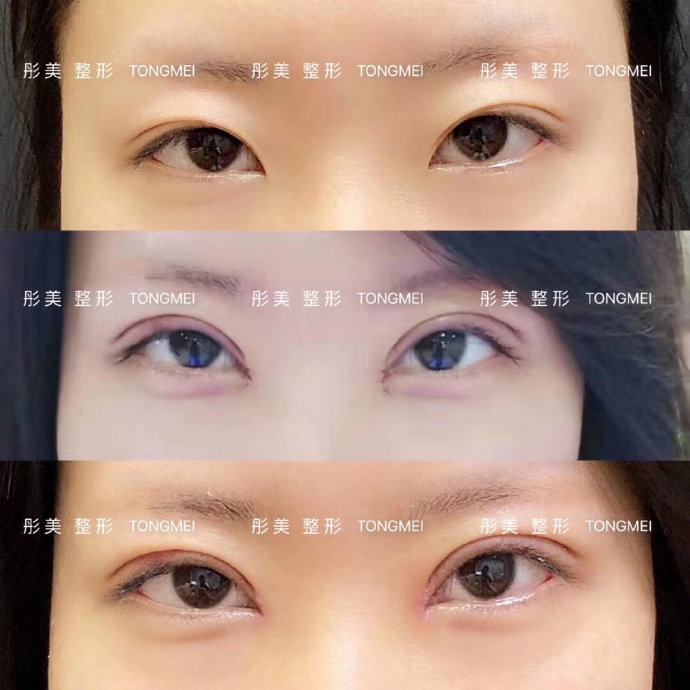 北京知名眼修复专家刘风卓（案例预约）双眼皮修复多少钱