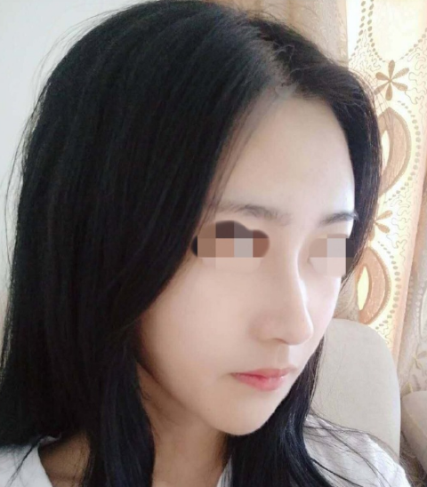 深圳鼻修复医生专家有哪些？向宏伟李晓平易普锋郑志敏徐荣阳隆鼻修复谁厉害？