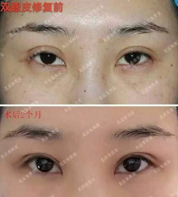 北京专做眼修复的医生：刘风卓王振军张冰洁王世勇白永辉韩勋双眼皮修复谁好？