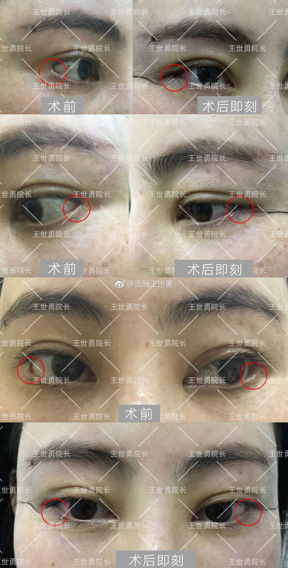 北京专做眼修复的医生：刘风卓王振军张冰洁王世勇白永辉韩勋双眼皮修复谁好？