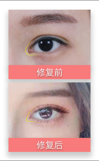 北京专做眼修复的医生：刘风卓王振军张冰洁王世勇白永辉韩勋双眼皮修复谁好？