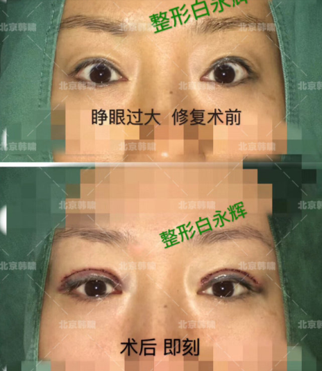北京专做眼修复的医生：刘风卓王振军张冰洁王世勇白永辉韩勋双眼皮修复谁好？