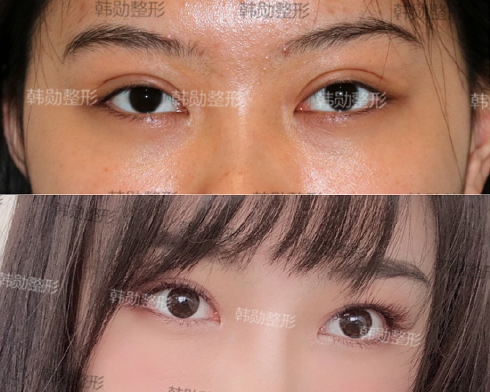 北京专做眼修复的医生：刘风卓王振军张冰洁王世勇白永辉韩勋双眼皮修复谁好？