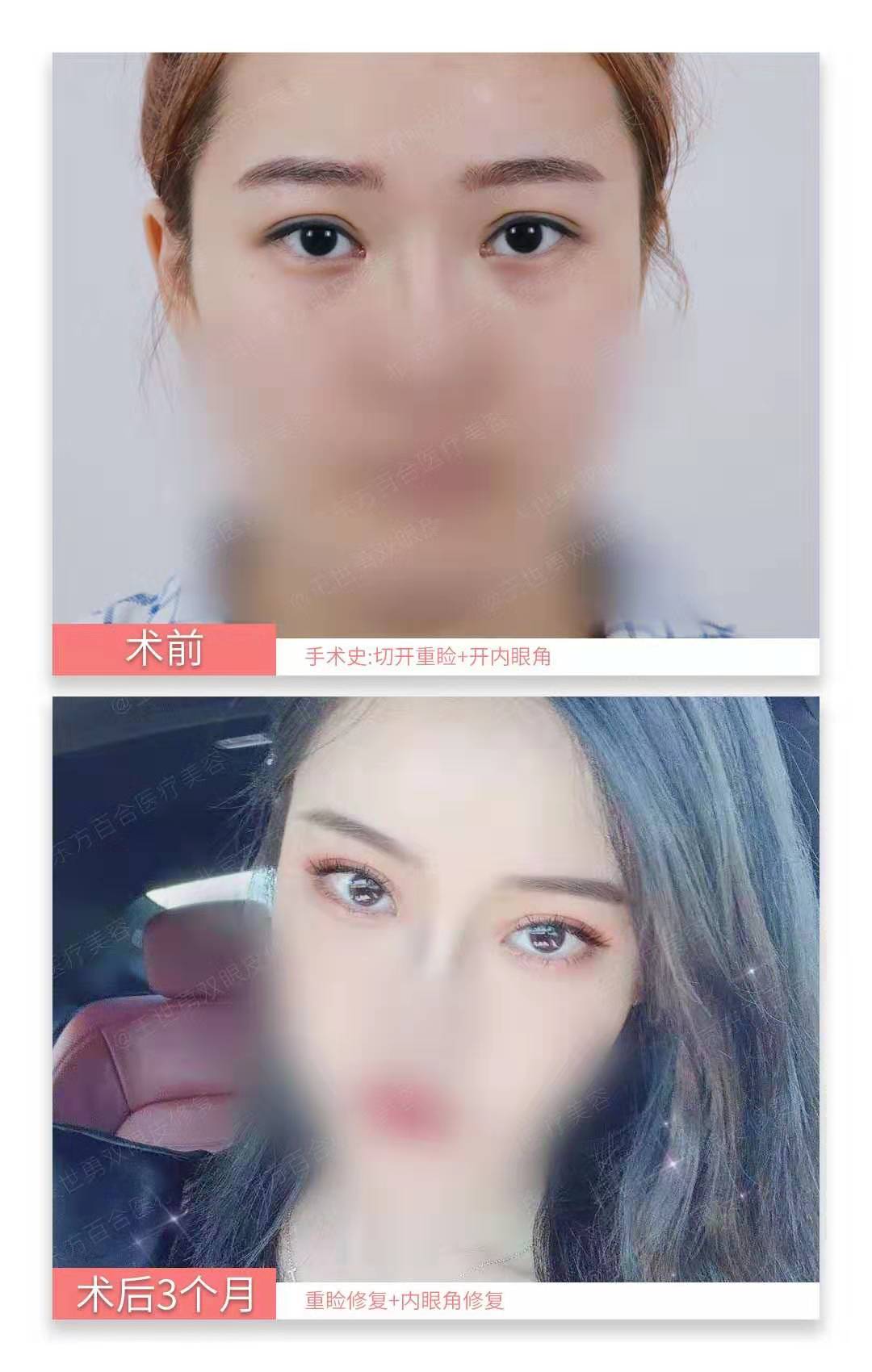 北京高难度内眼角修复医生都有哪些？王世勇张冰洁王振军刘风卓谁更好？