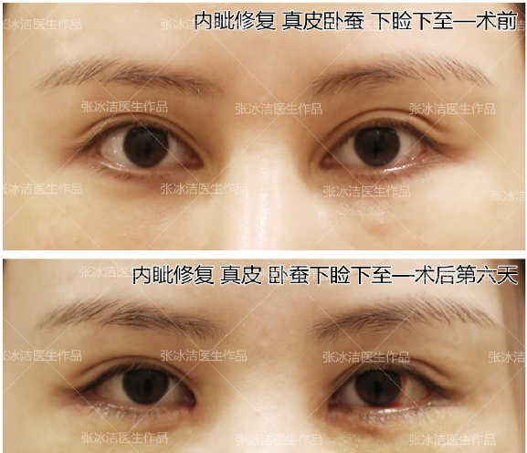 北京高难度内眼角修复医生都有哪些？王世勇张冰洁王振军刘风卓谁更好？