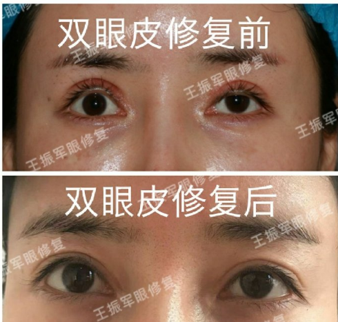 北京高难度内眼角修复医生都有哪些？王世勇张冰洁王振军刘风卓谁更好？