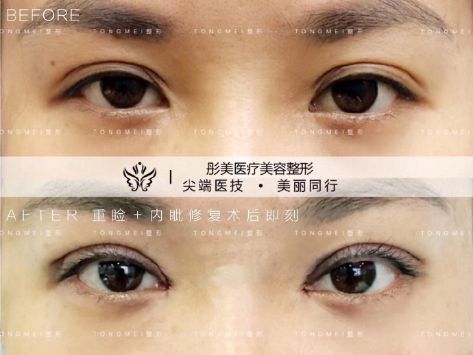 北京高难度内眼角修复医生都有哪些？王世勇张冰洁王振军刘风卓谁更好？