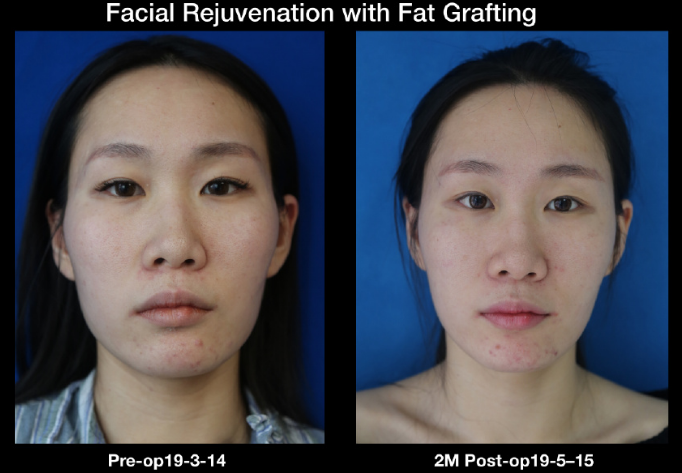 上海脂肪填充整形医院哪个好？上海九院伊莱美百达丽艺星美莱谁最好？