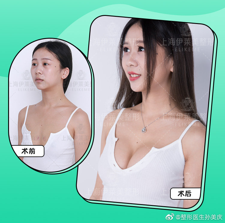 上海脂肪填充整形医院哪个好？上海九院伊莱美百达丽艺星美莱谁最好？