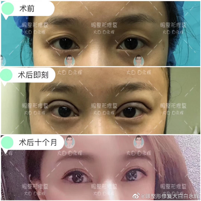 国内最好的修复双眼皮医生：双眼皮修复白永辉和刘志刚（预约）哪个手艺高？
