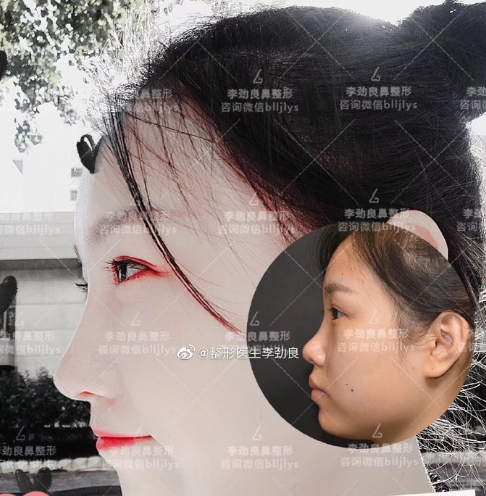 北京鼻综合十大专家都有哪些？北京隆鼻医生前十名排名