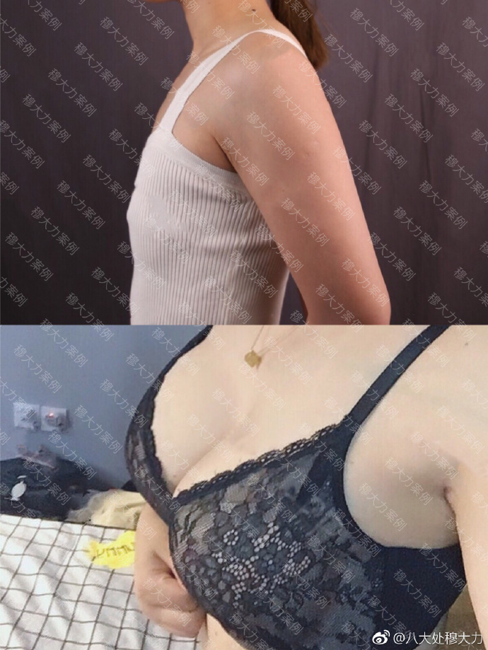 北京八大处脂肪丰胸医生都有哪些？八大处脂肪丰胸专家（预约）排名