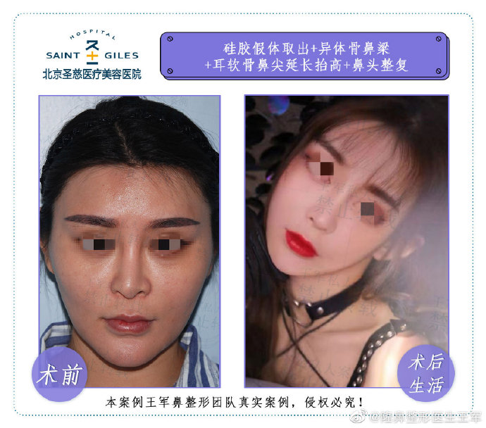 北京肋骨鼻做得比较好的医生:刘彦军王军巫文云薛志强李劲良（预约）肋骨隆鼻谁厉害？