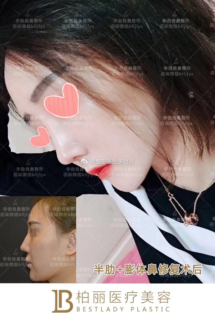 北京肋骨鼻做得比较好的医生:刘彦军王军巫文云薛志强李劲良（预约）肋骨隆鼻谁厉害？