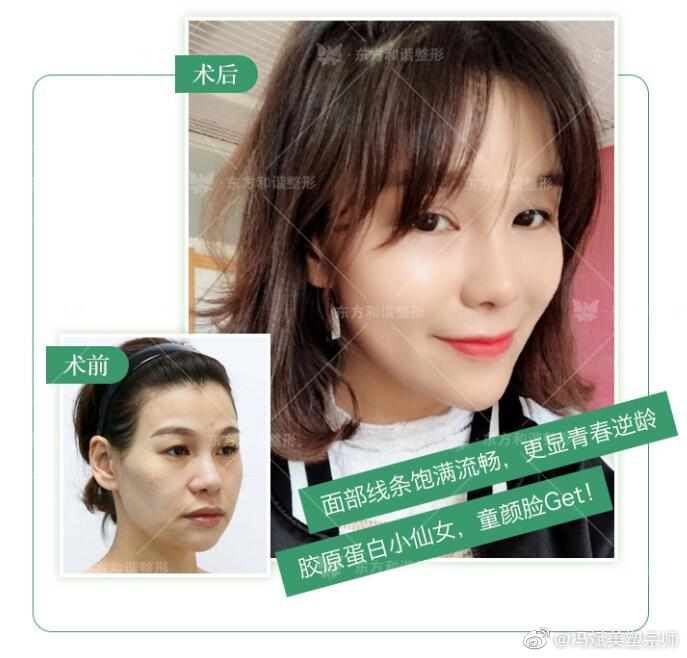 北京脂肪填充名医都有哪些呢？北京做自体脂肪填充最好的专家排名