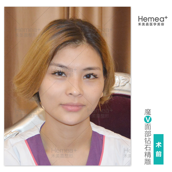 北京脂肪填充名医都有哪些呢？北京做自体脂肪填充最好的专家排名