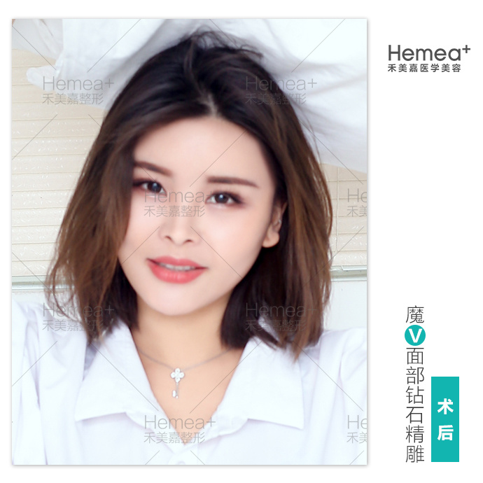 北京脂肪填充名医都有哪些呢？北京做自体脂肪填充最好的专家排名