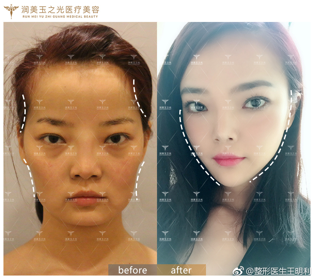 北京脂肪填充名医都有哪些呢？北京做自体脂肪填充最好的专家排名