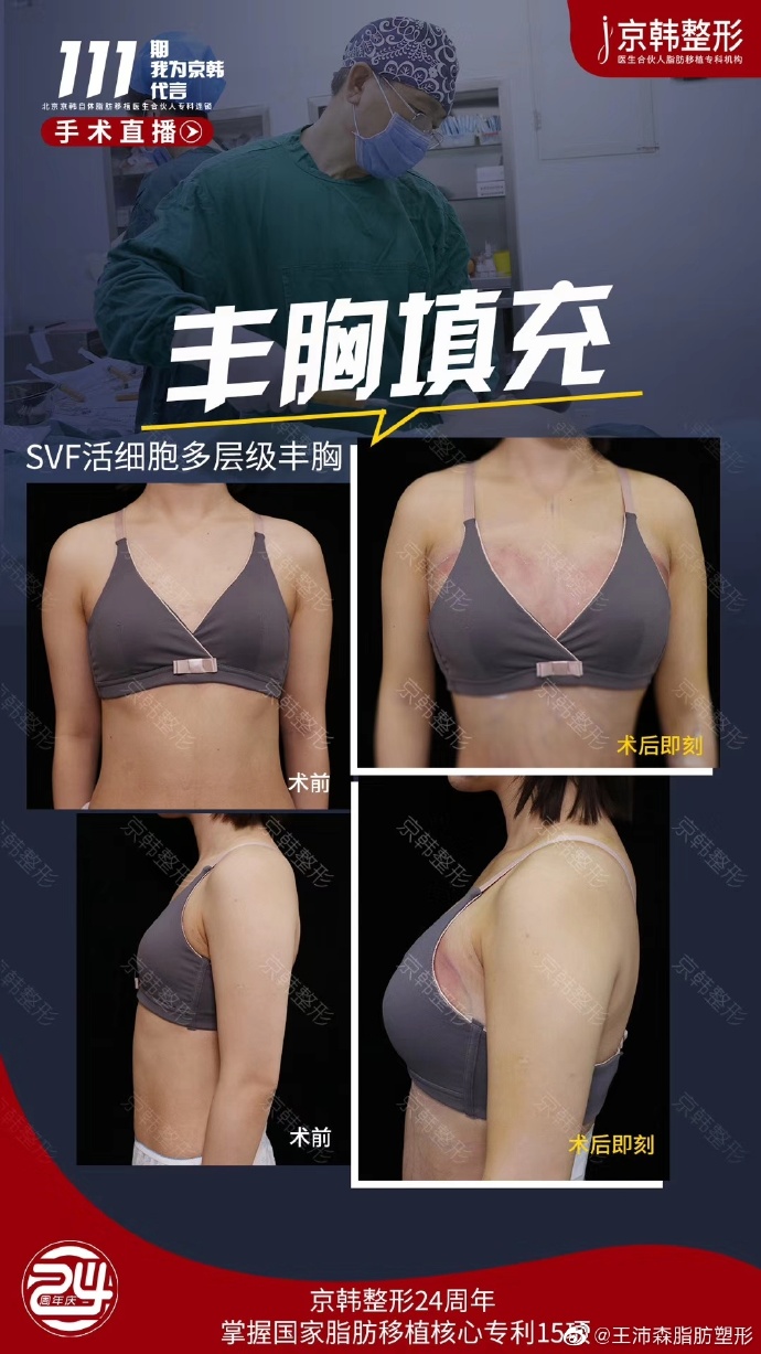 北京脂肪填充名医都有哪些呢？北京做自体脂肪填充最好的专家排名