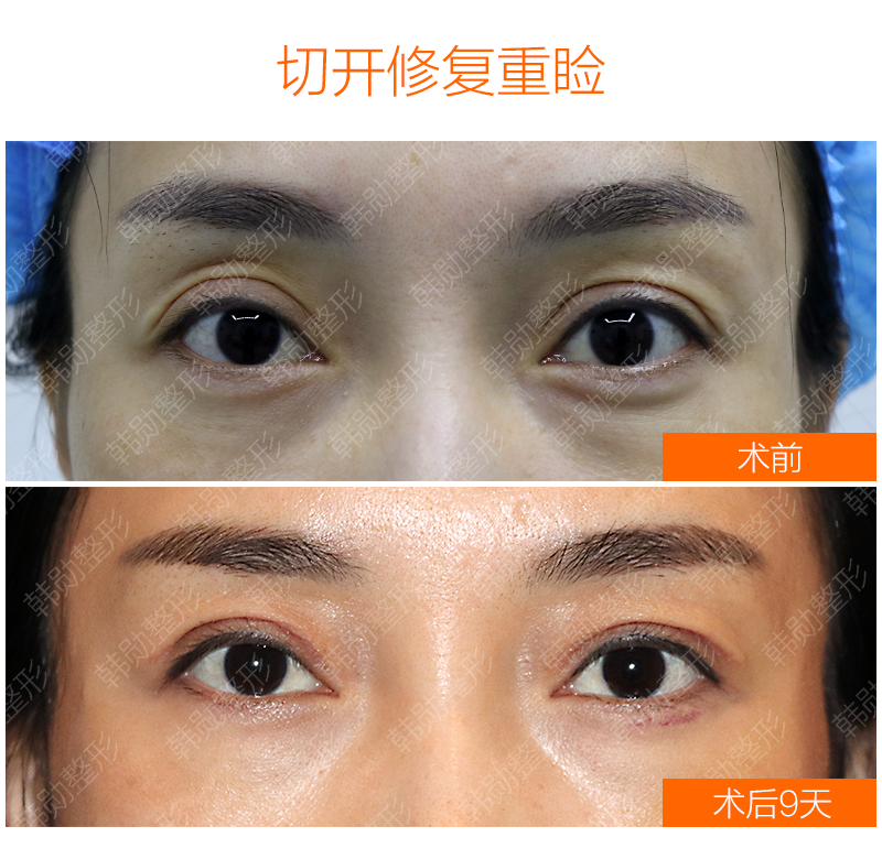 韩勋和白永辉哪个高难度修复手术（上睑下垂）做的比较好？