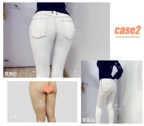 上海百达丽医院自体脂肪丰臀怎么样？沈国雄怎么预约多少钱？