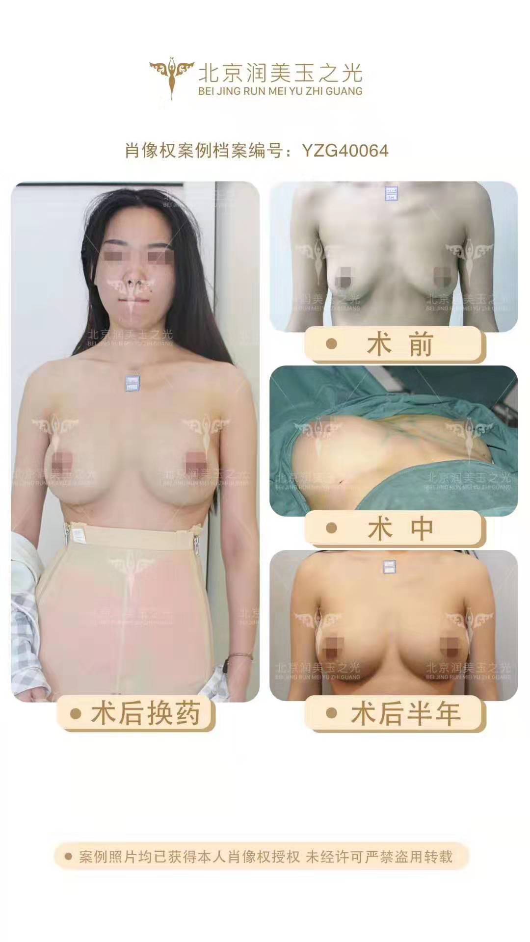 王明利李朕王沛森乔爱军哪个做自体脂肪丰胸好？预约案例