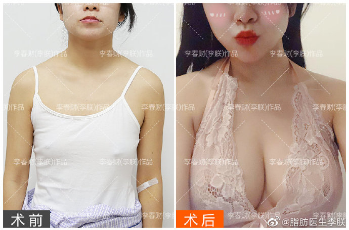 王明利李朕王沛森乔爱军哪个做自体脂肪丰胸好？预约案例