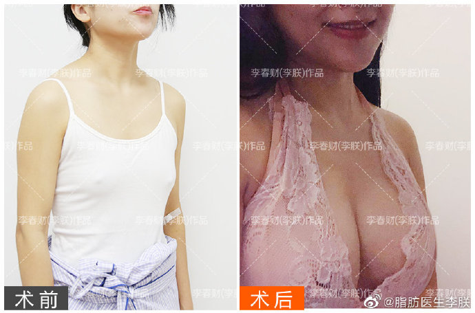 王明利李朕王沛森乔爱军哪个做自体脂肪丰胸好？预约案例