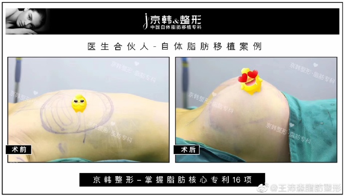 王明利李朕王沛森乔爱军哪个做自体脂肪丰胸好？预约案例