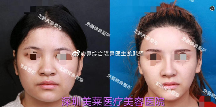 2020年深圳鼻综合的医生排名:向宏伟陈桂飞罗志敏尹卫民牛克辉龙鹏辉