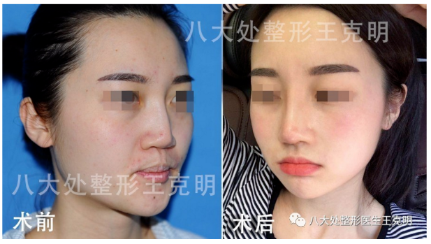 北京隆鼻哪个专家比较好？王克明刘暾范飞李劲良刘彦军王军隆鼻预约