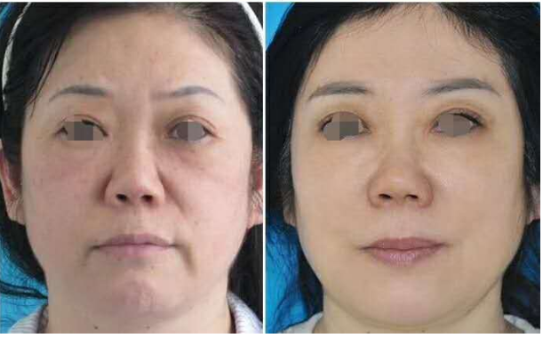 北京八大处做拉皮哪个医生好？杨欣赵延勇侯典举面部拉皮哪个好？